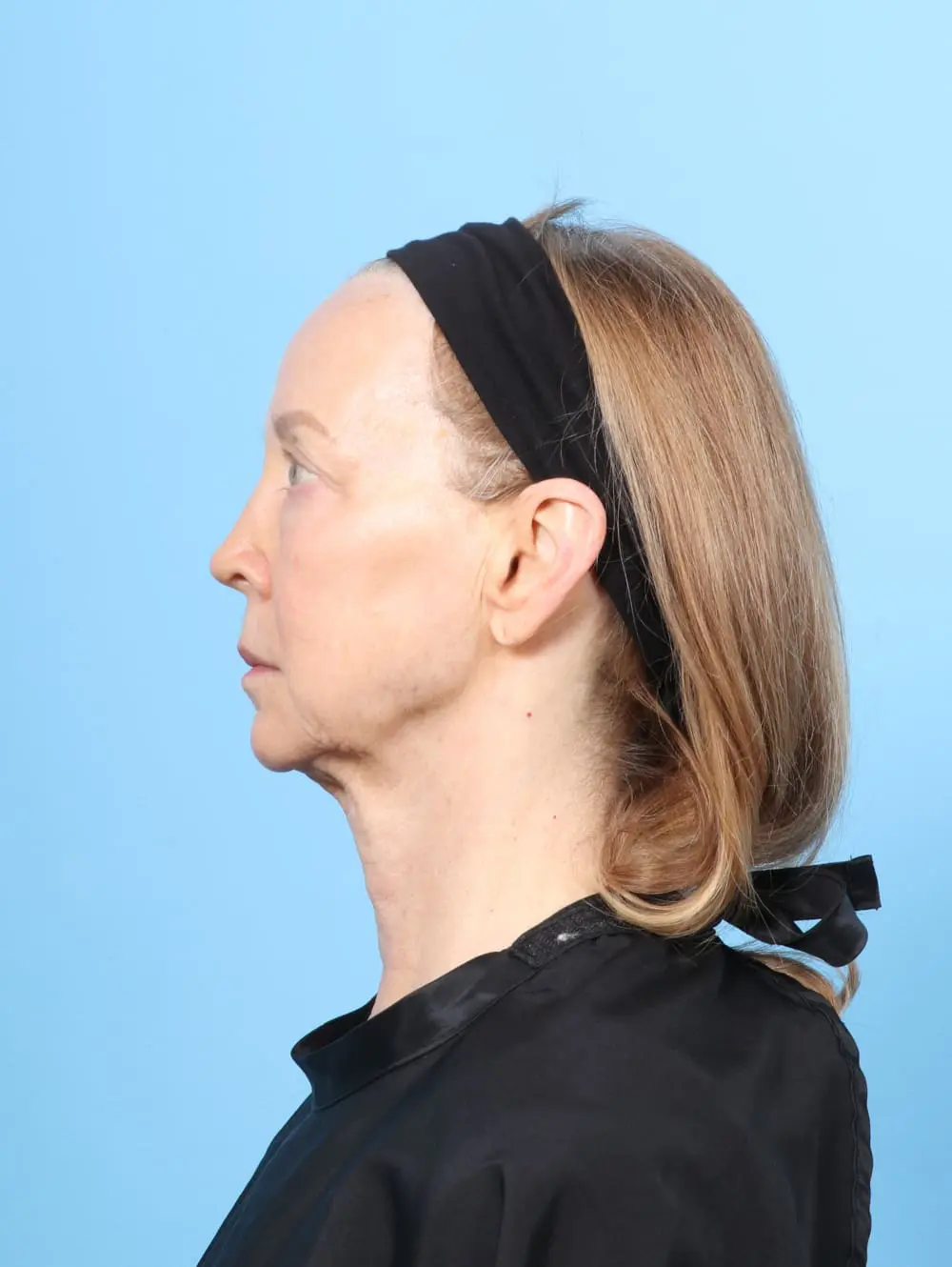 Facelift / Neck Lift Patient Photo - Case 62183 - before view-2