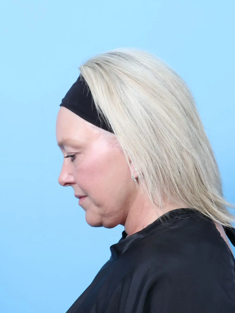 Facelift / Neck Lift Patient Photo - Case 62208 - after view-3
