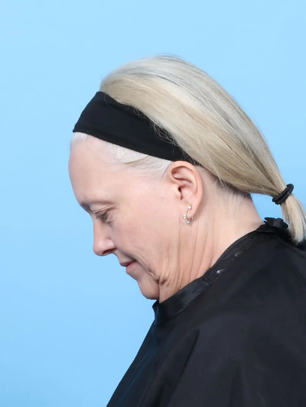 Facelift / Neck Lift Patient Photo - Case 62208 - before view-3