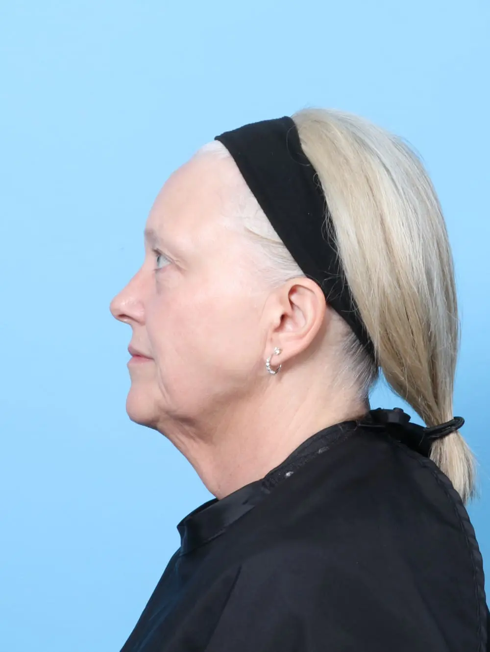 Facelift / Neck Lift Patient Photo - Case 62208 - before view-2