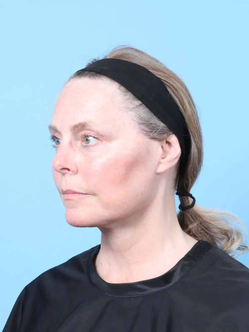 Eyelid Surgery Patient Photo - Case 62210 - after view-1