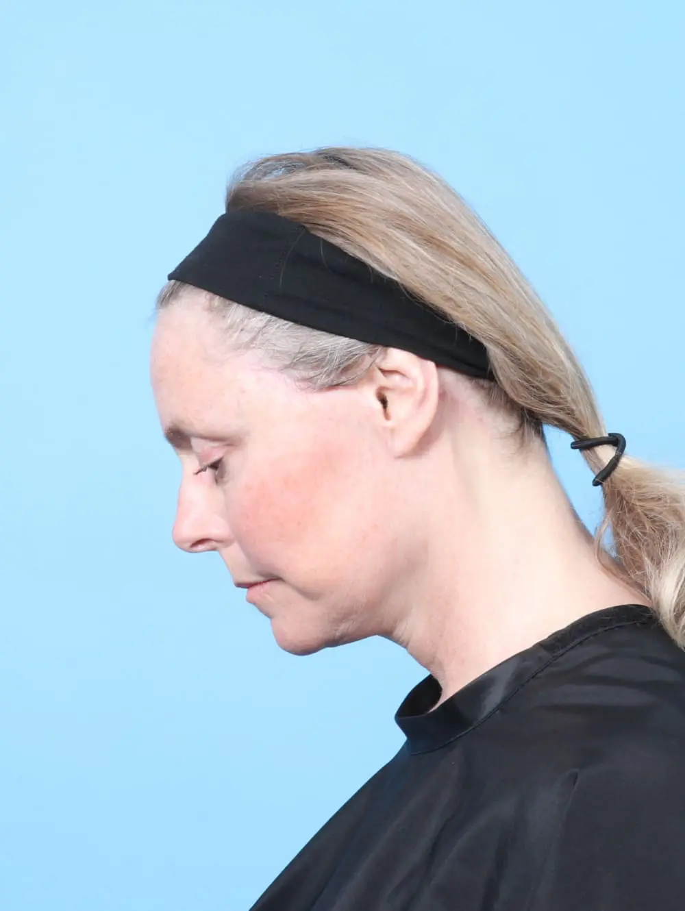 Eyelid Surgery Patient Photo - Case 62210 - after view-3