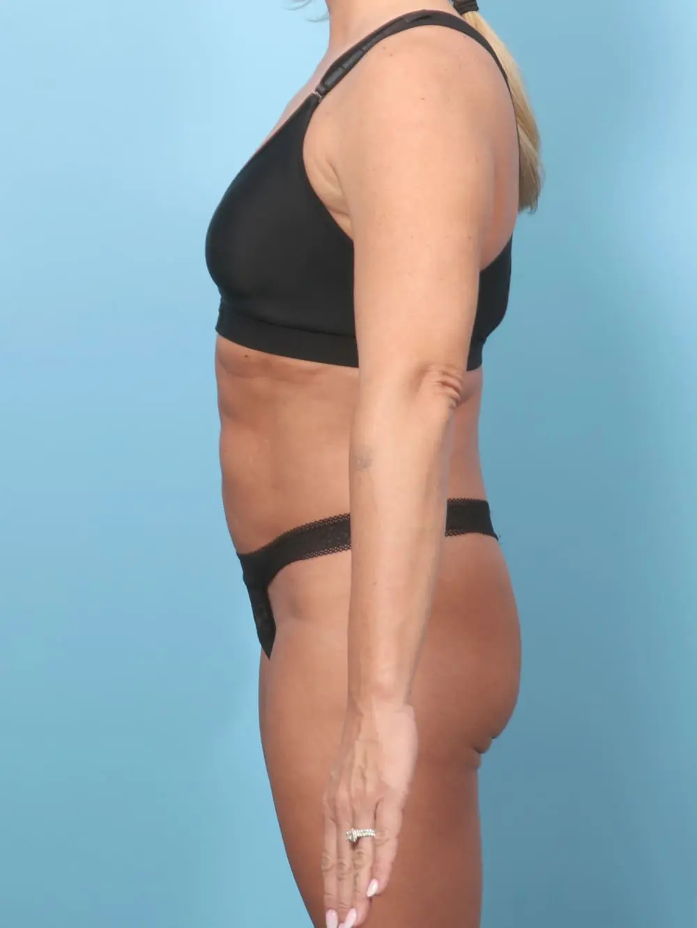 Tummy Tuck Patient Photo - Case 62269 - before view-2
