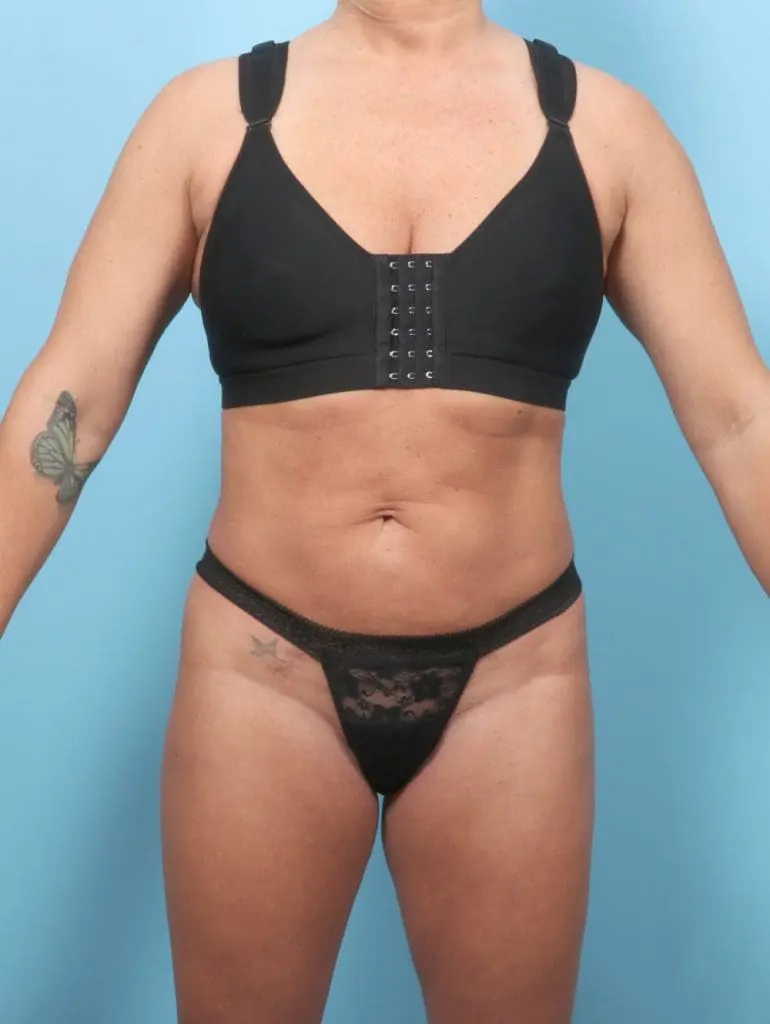 Tummy Tuck - Case 62269 - Before