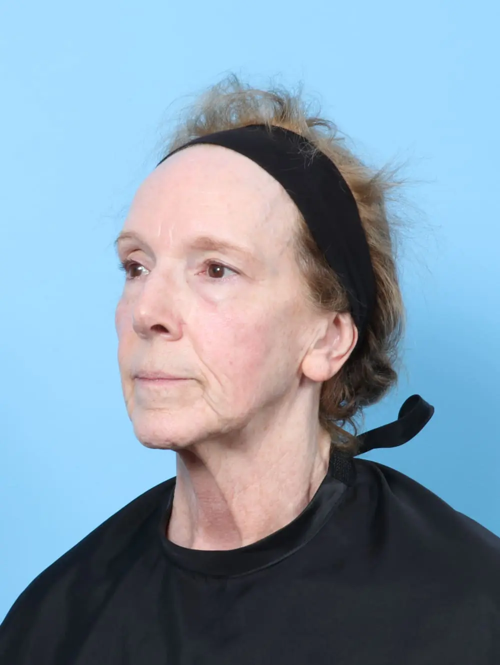 Bullhorn Lip Lift Patient Photo - Case 62277 - before view-1