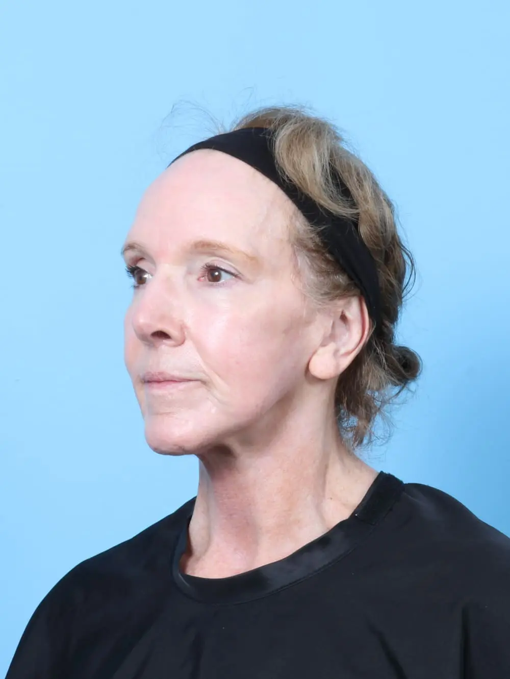 Bullhorn Lip Lift Patient Photo - Case 62277 - after view-1