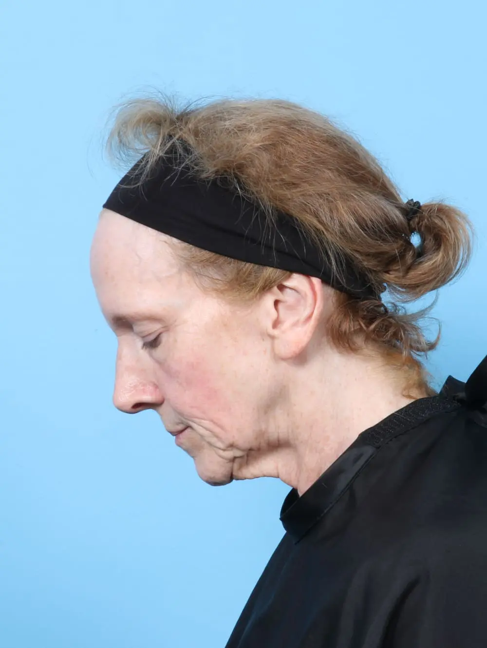 Bullhorn Lip Lift Patient Photo - Case 62277 - before view-3