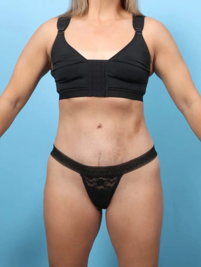 Tummy Tuck - Case 62307 - After