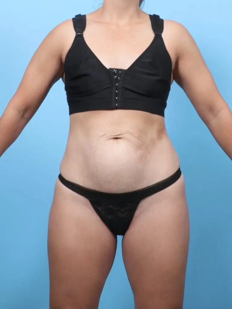 Tummy Tuck - Case 62307 - Before