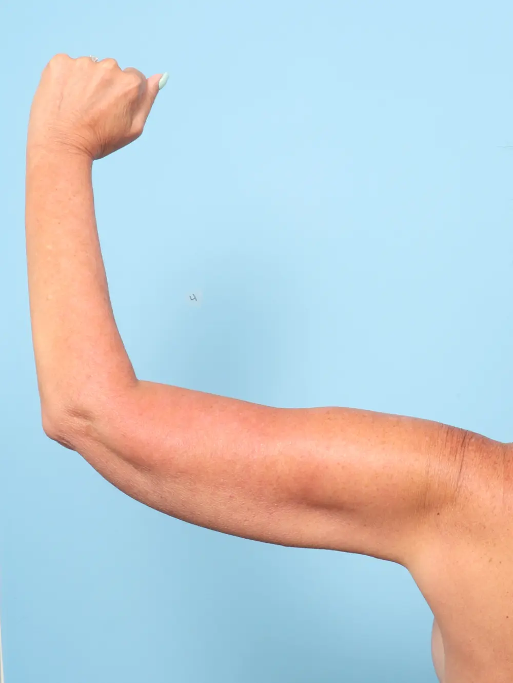 Arm Lift Patient Photo - Case 62370 - after view-1