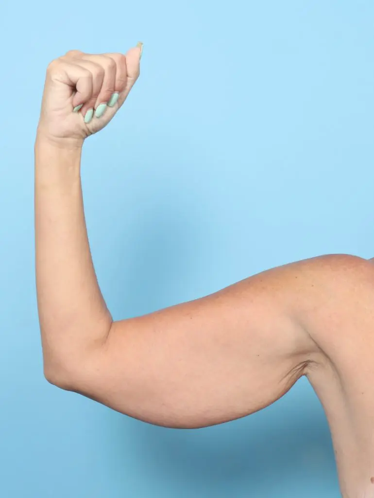 Arm Lift - Case 62370 - Before