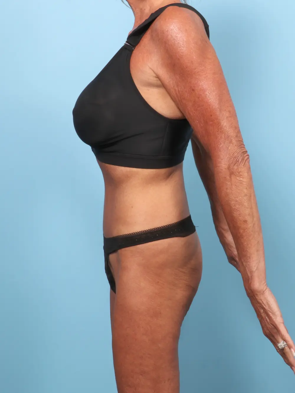 Tummy Tuck Patient Photo - Case 62388 - after view-2