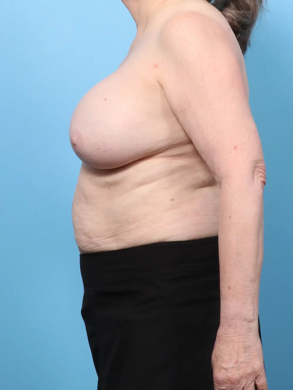 Breast Implant Removal Patient Photo - Case 62412 - before view-2