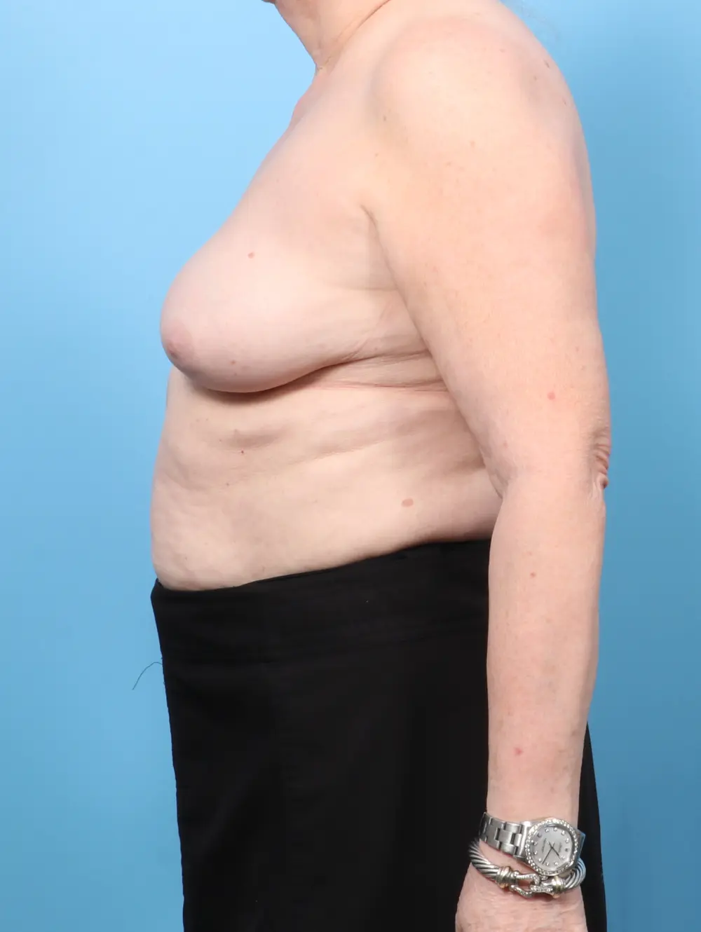 Breast Implant Removal Patient Photo - Case 62412 - after view-2