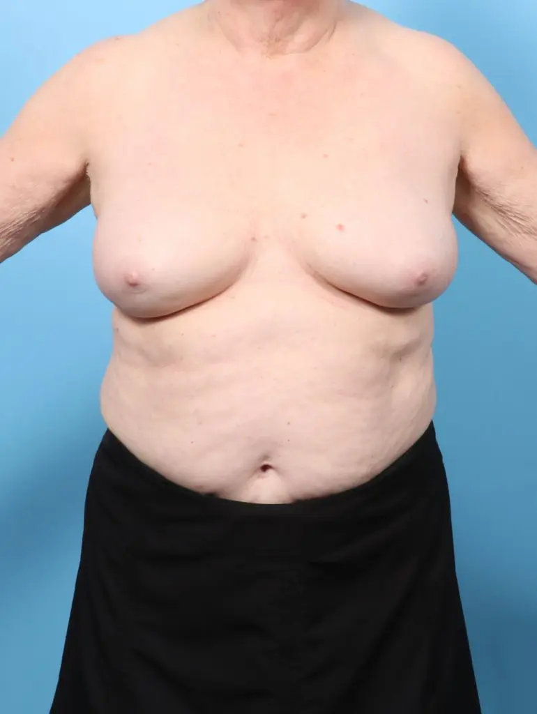 Breast Implant Removal - Case 62412 - After