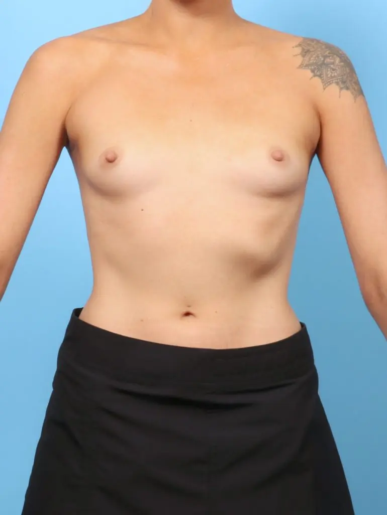 Breast Augmentation - Case 62461 - Before