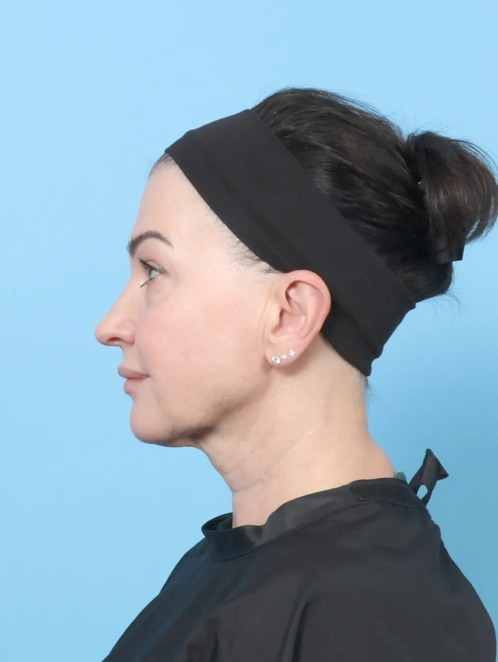 Facelift / Neck Lift Patient Photo - Case 62469 - before view-2