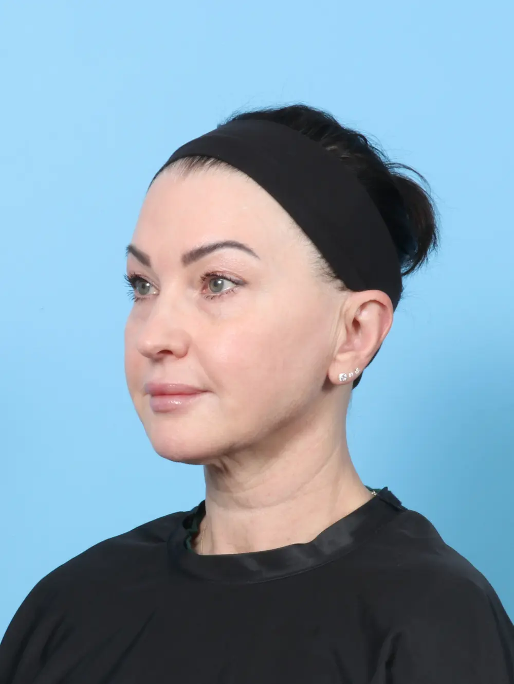 Facelift / Neck Lift Patient Photo - Case 62469 - before view-1