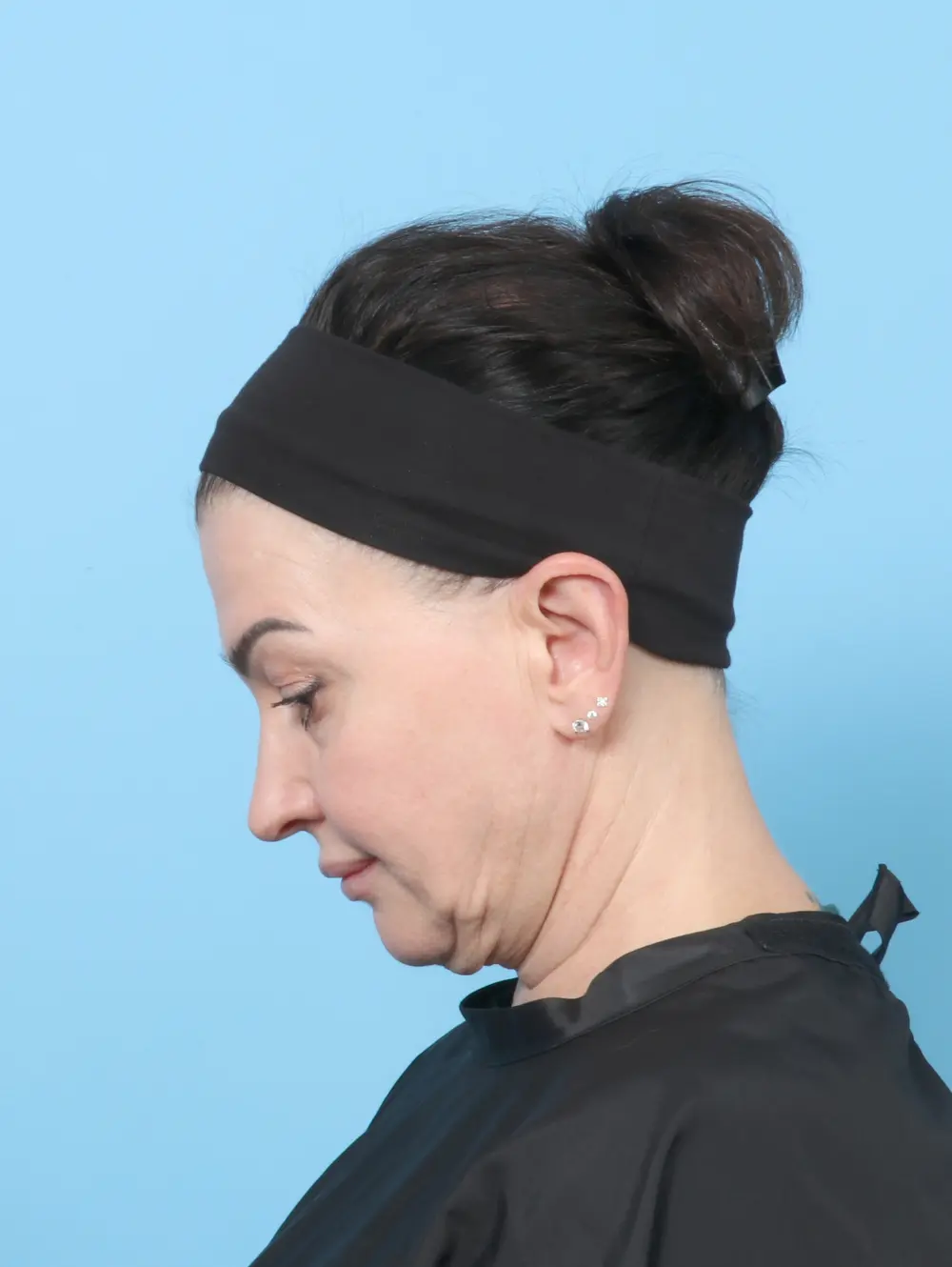 Facelift / Neck Lift Patient Photo - Case 62469 - before view-3