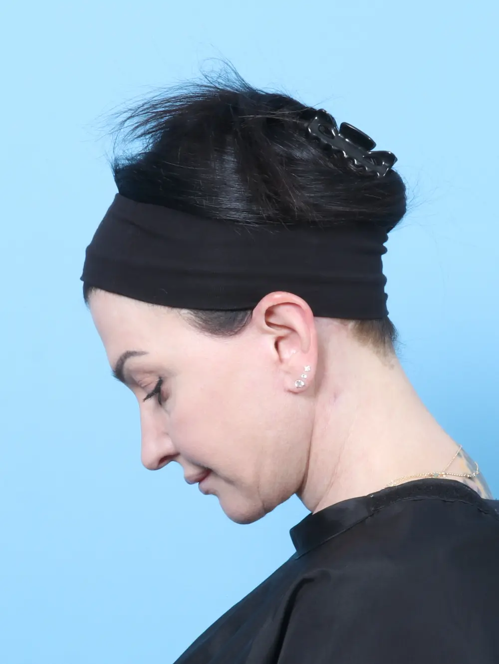 Facelift / Neck Lift Patient Photo - Case 62469 - after view-3