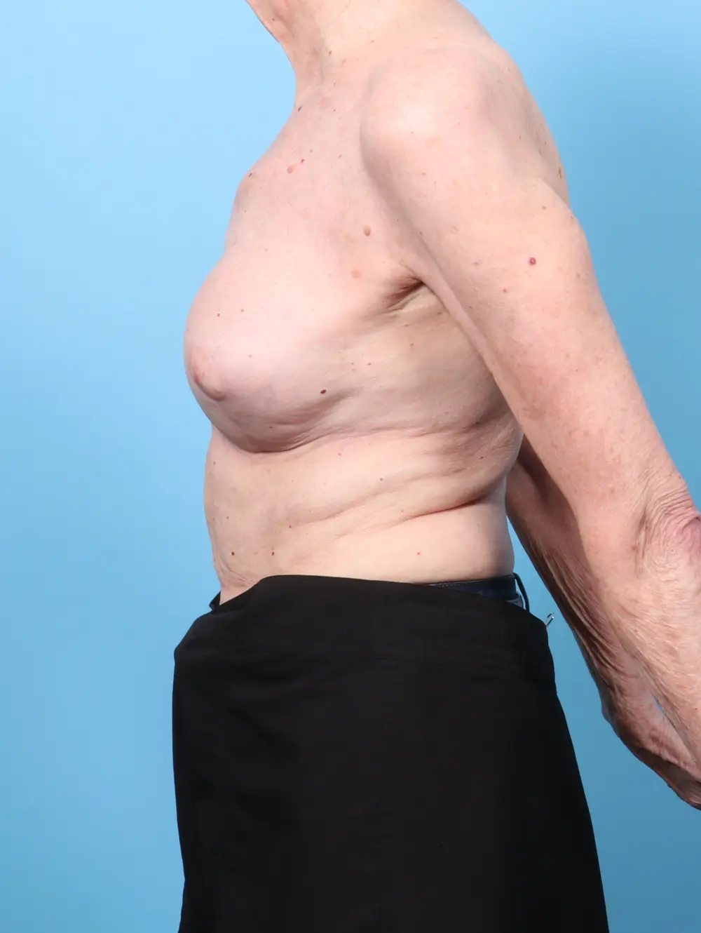 Breast Implant Revision Patient Photo - Case 62499 - after view-2