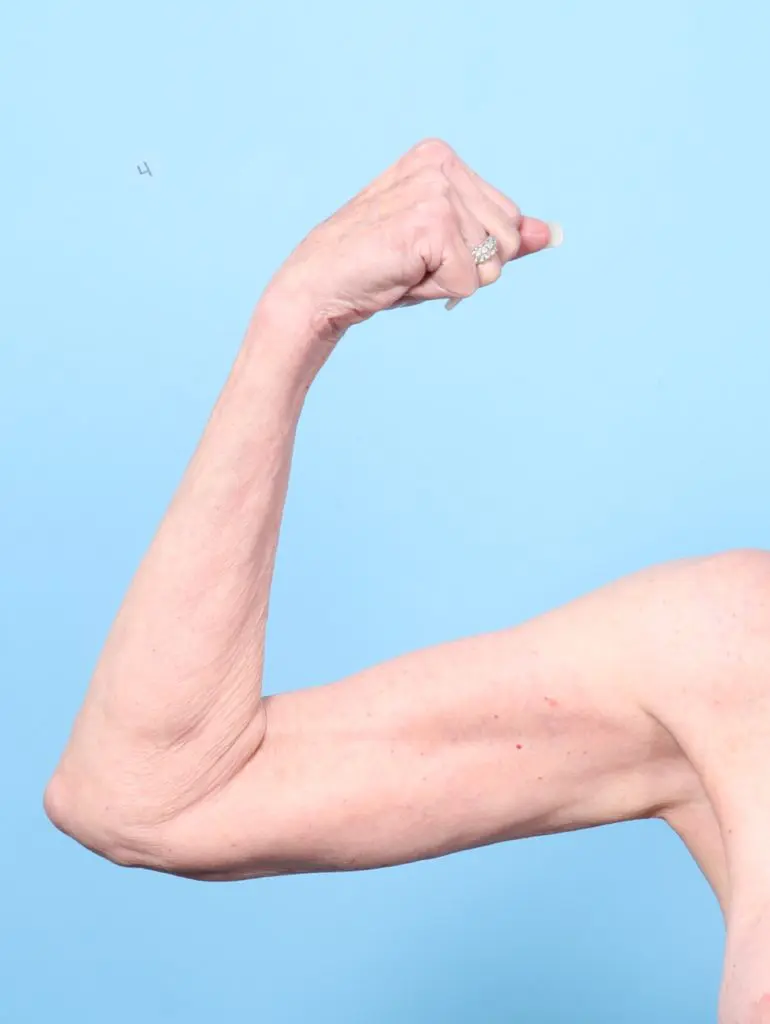 Arm Lift - Case 62487 - After