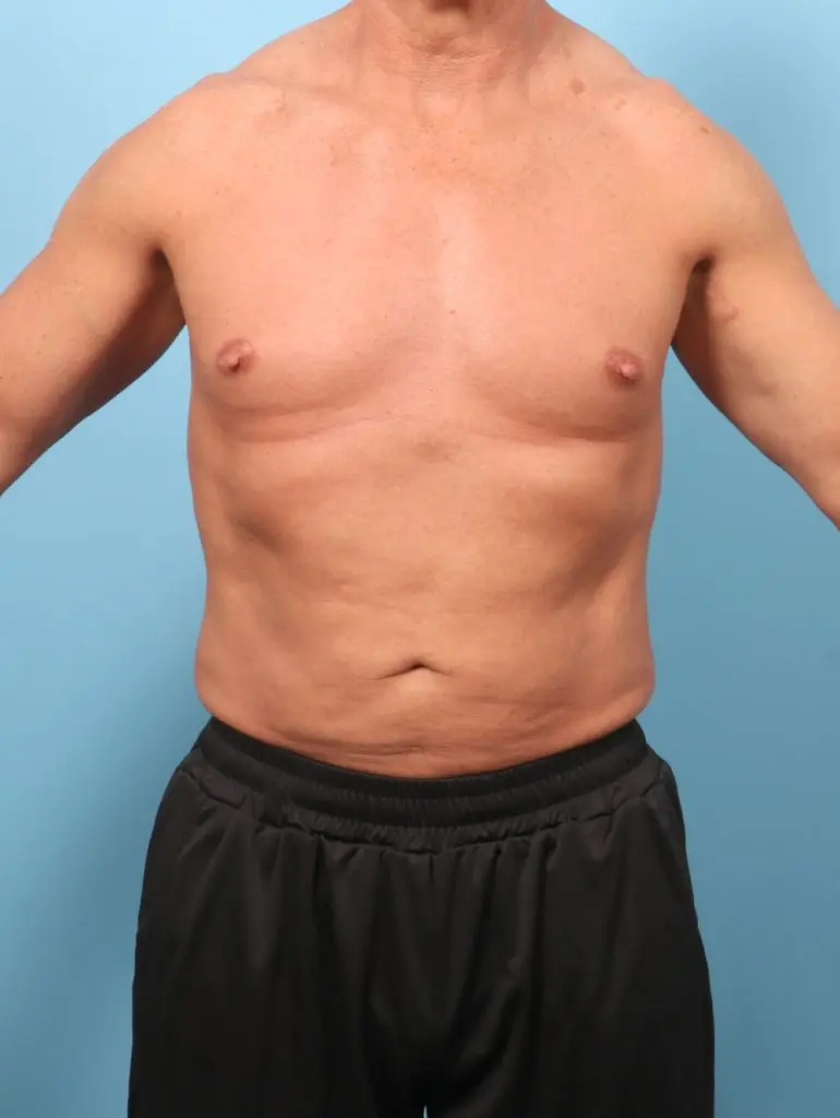 Liposuction - Case 62531 - After