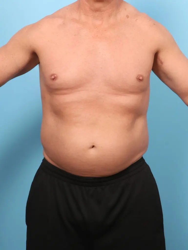 Liposuction - Case 62531 - Before