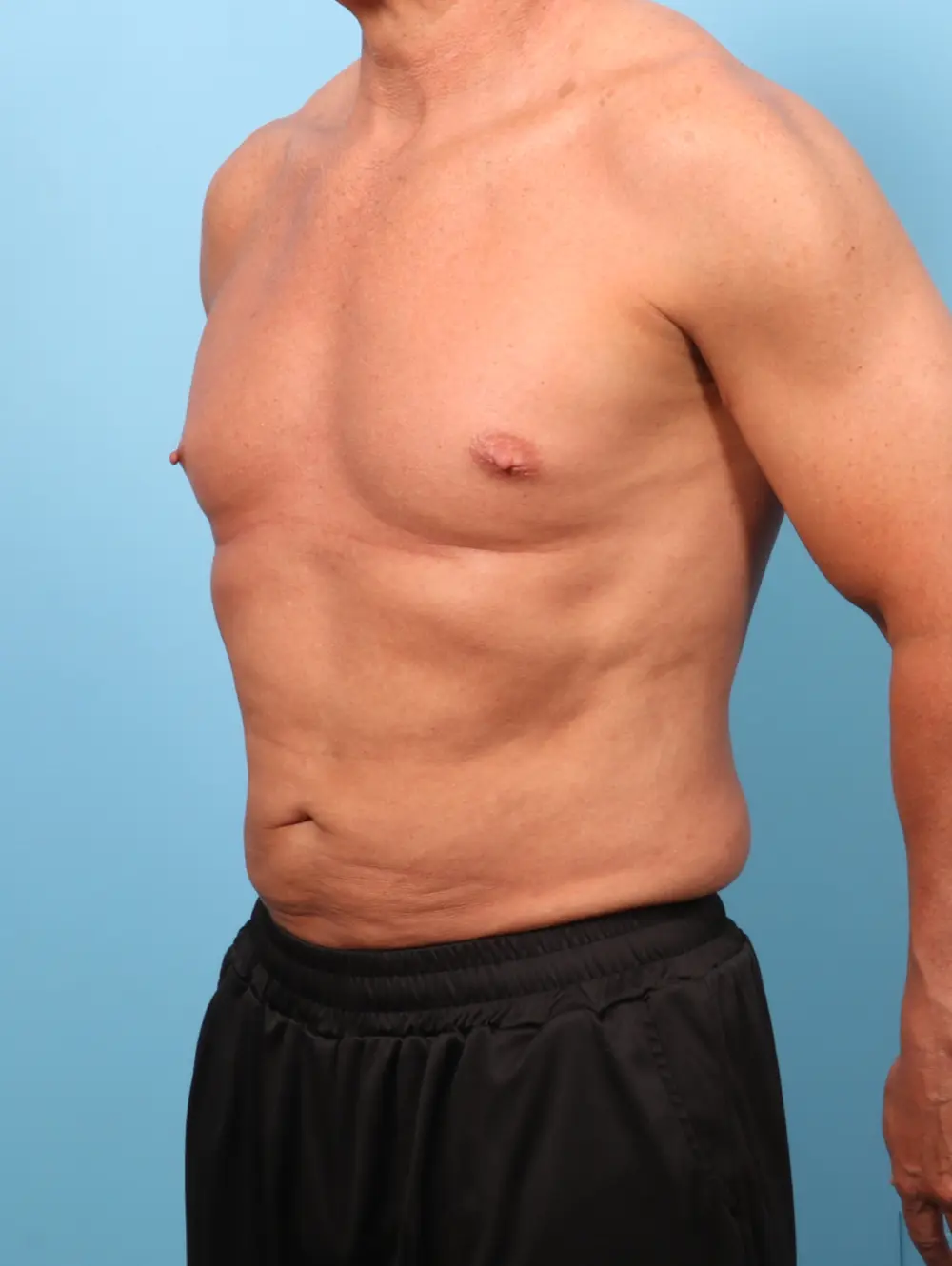 Liposuction Patient Photo - Case 62531 - after view-1