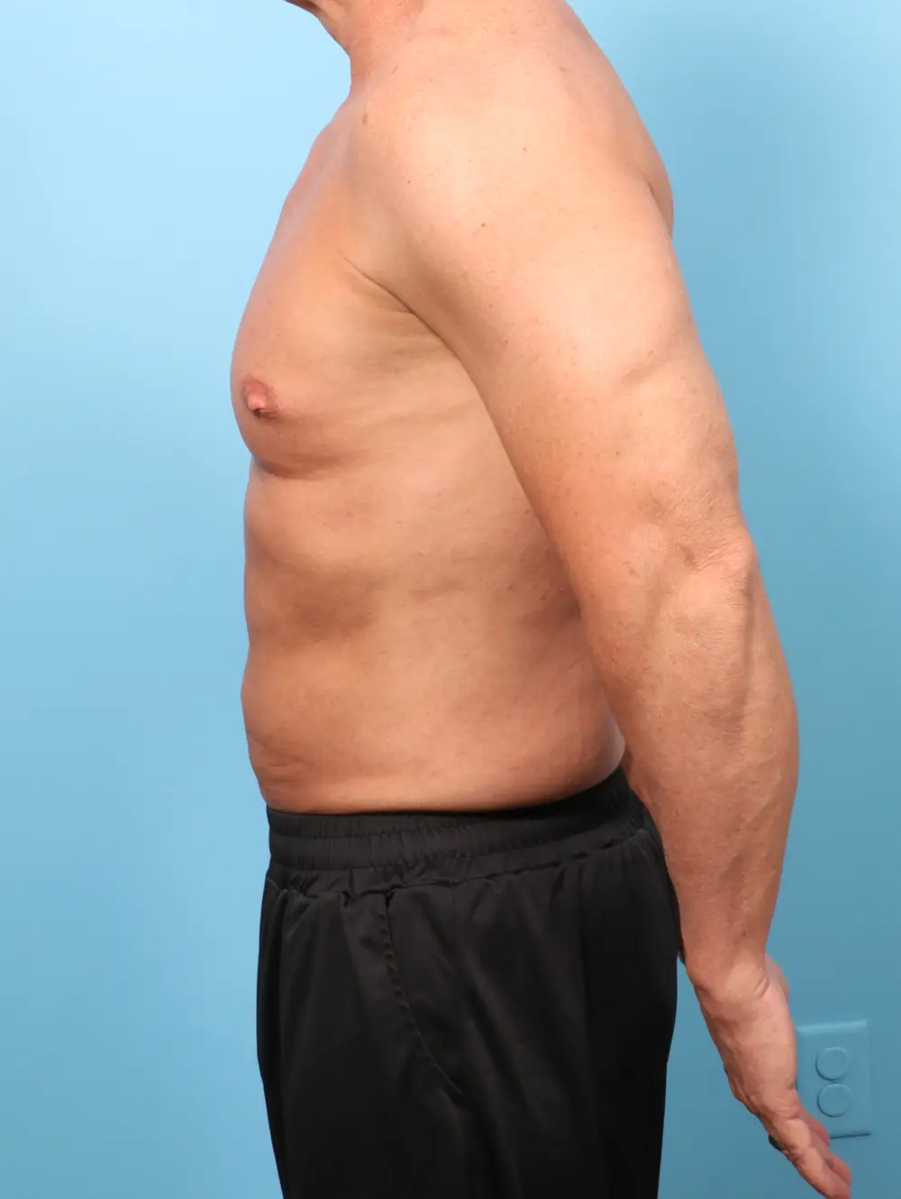 Liposuction Patient Photo - Case 62531 - after view-2
