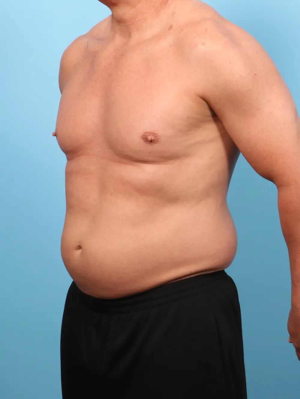 Liposuction Patient Photo - Case 62531 - before view-1