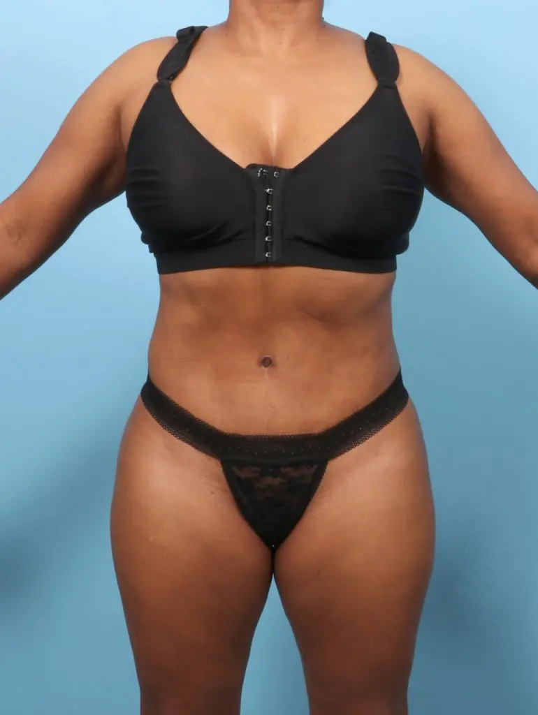 Tummy Tuck - Case 62682 - After
