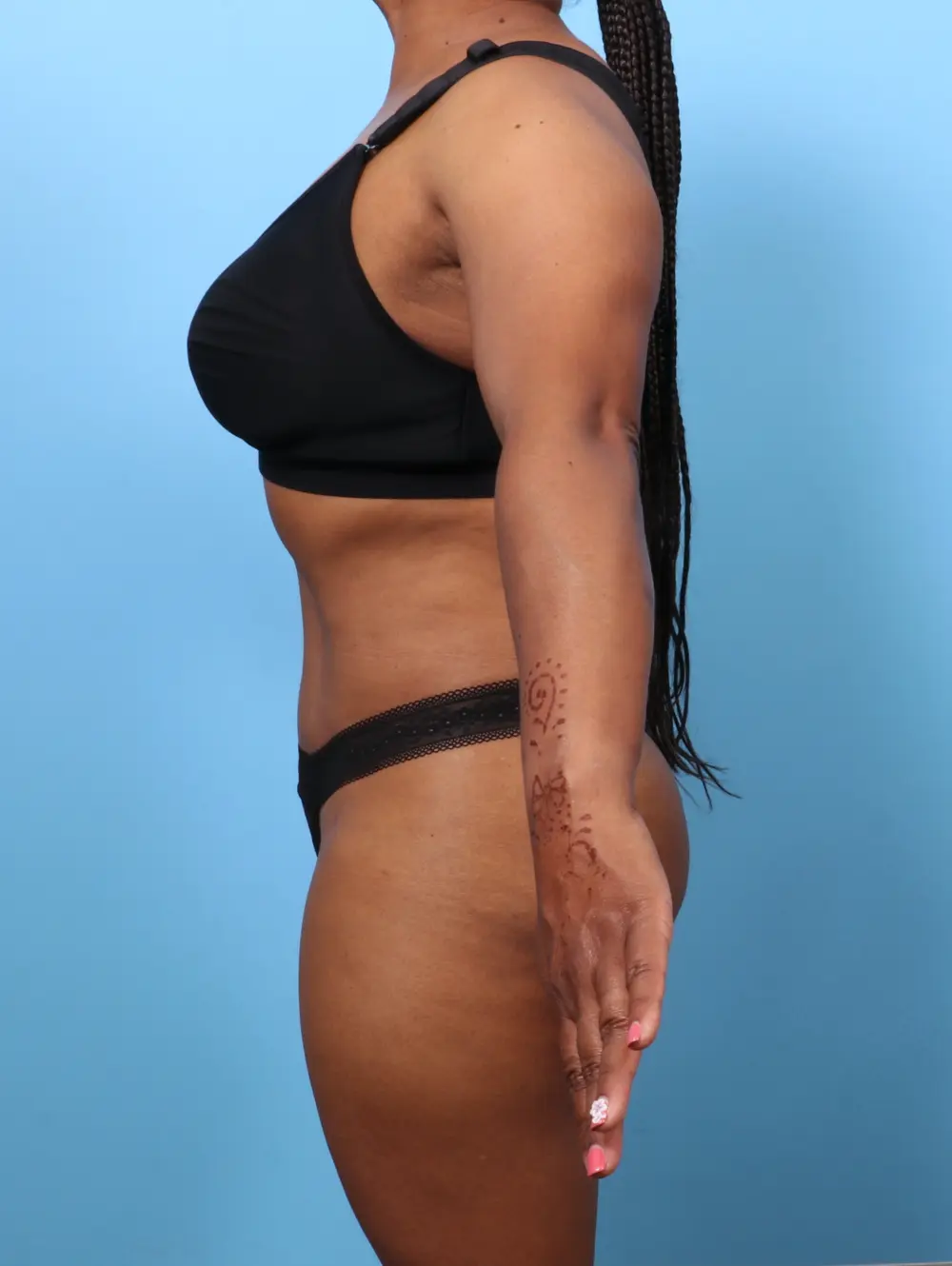 Tummy Tuck Patient Photo - Case 62682 - after view-2