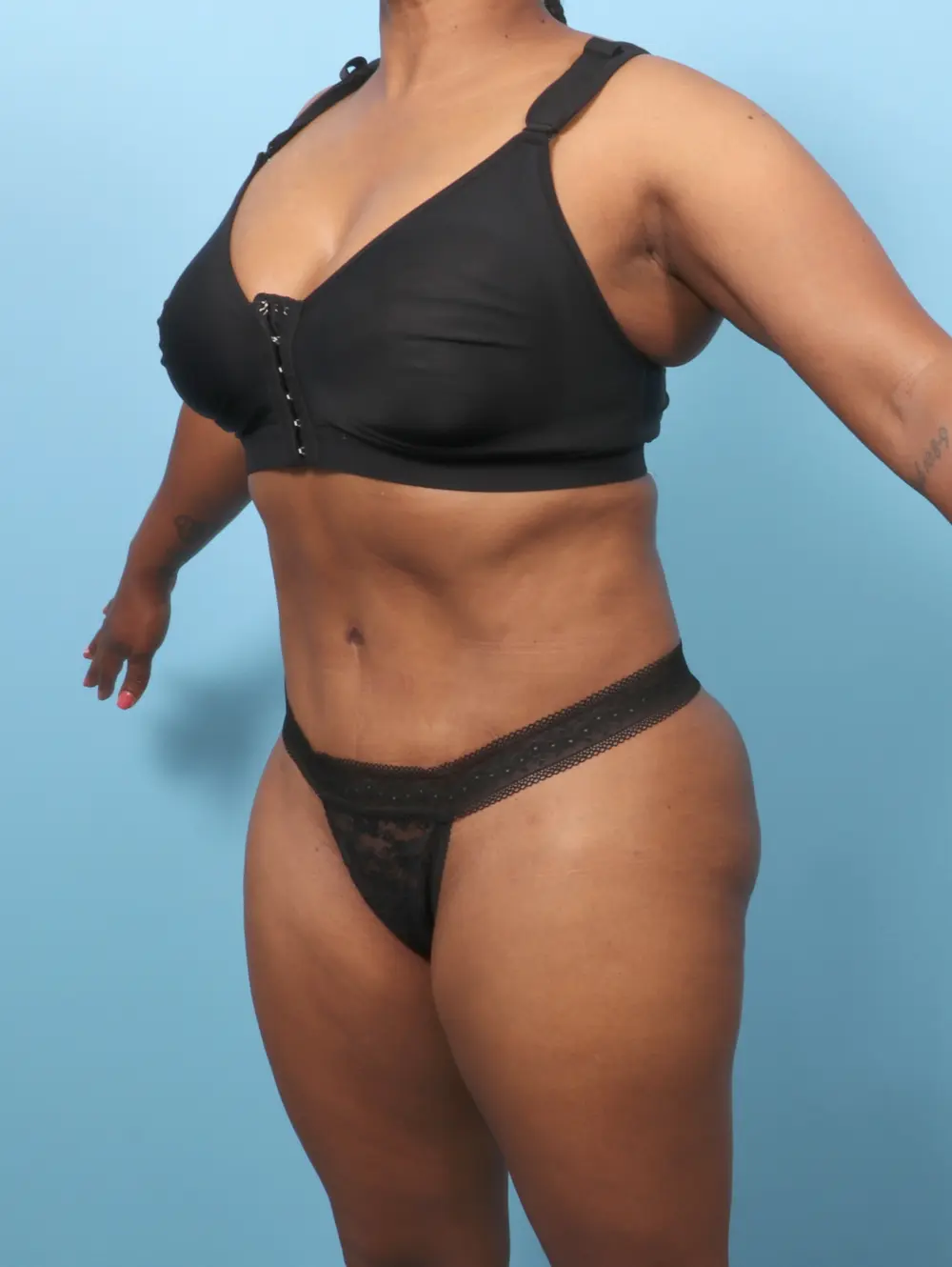 Tummy Tuck Patient Photo - Case 62682 - after view-1