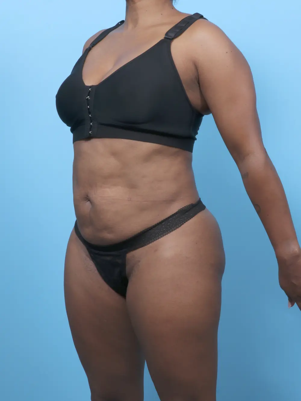 Tummy Tuck Patient Photo - Case 62682 - before view-1