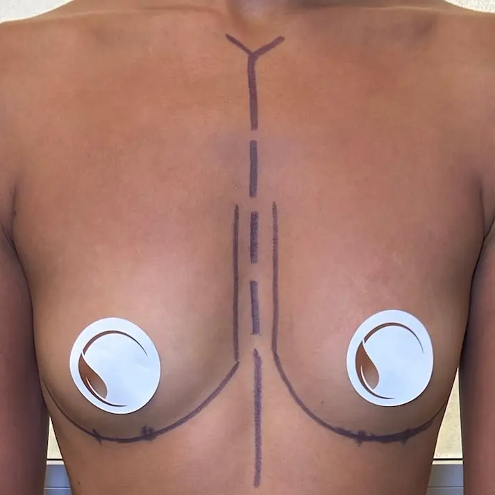 Breast Implant Planning Thumbnail woman's chest marked for surgery