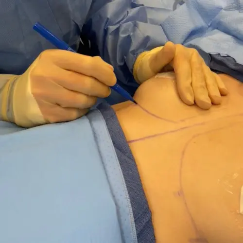 Screenshot surgeon beginning breast augmentation procedure