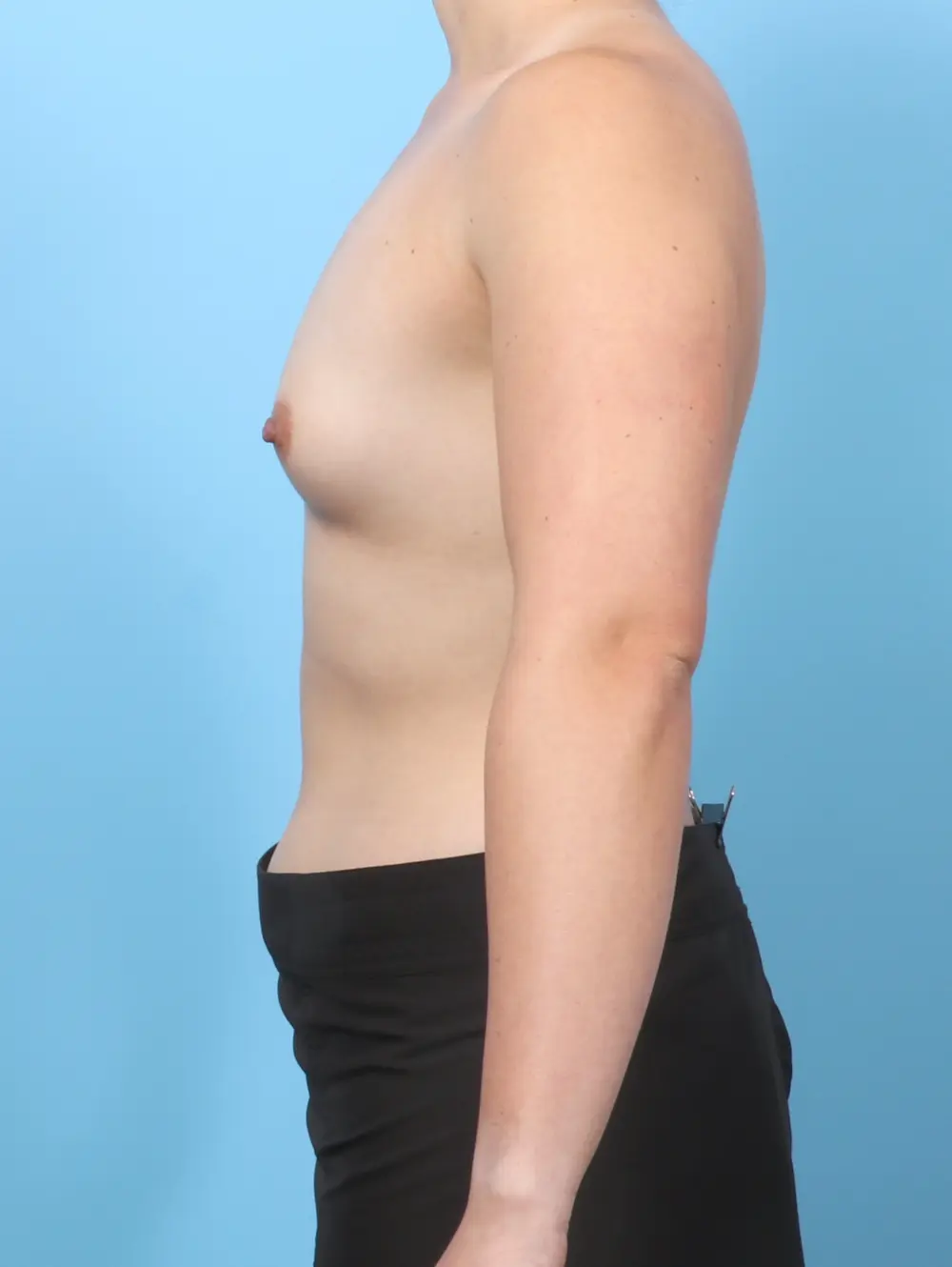 Breast Augmentation Patient Photo - Case 62752 - before view-2