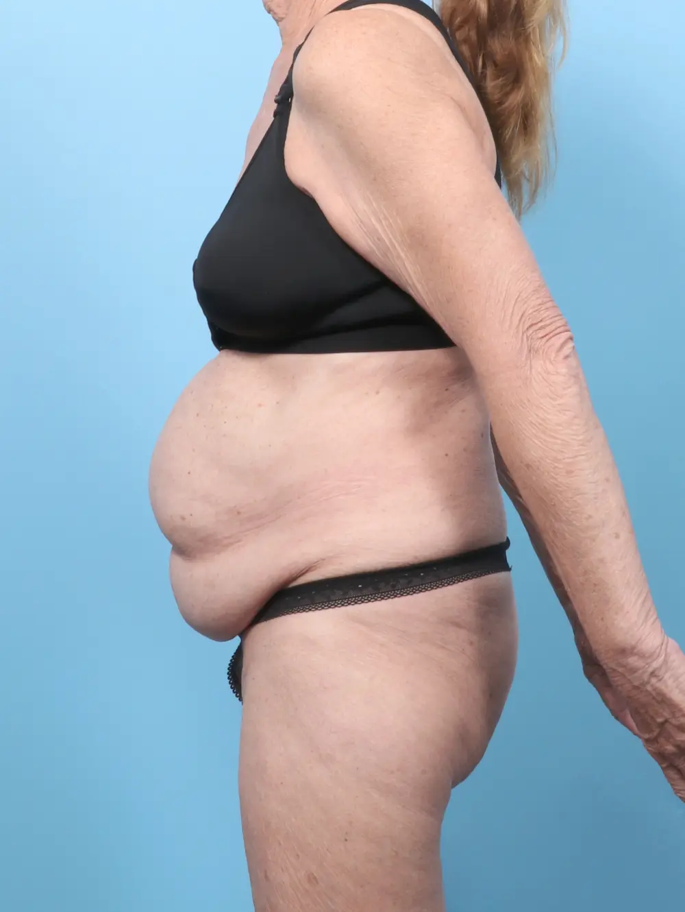 Tummy Tuck Patient Photo - Case 62870 - before view-2