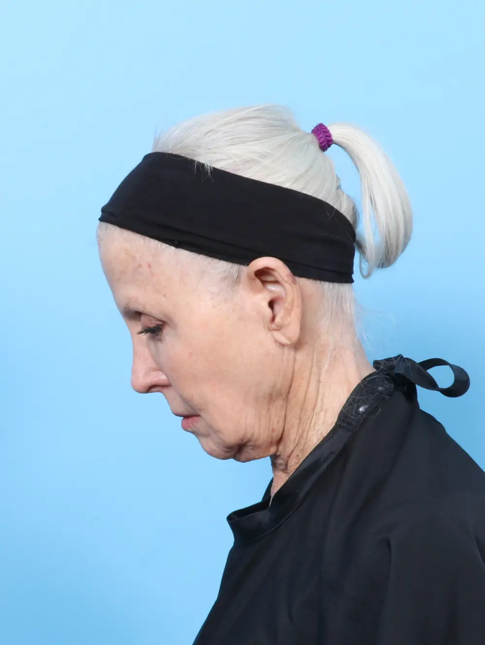 Facelift / Neck Lift Patient Photo - Case 62886 - before view-3