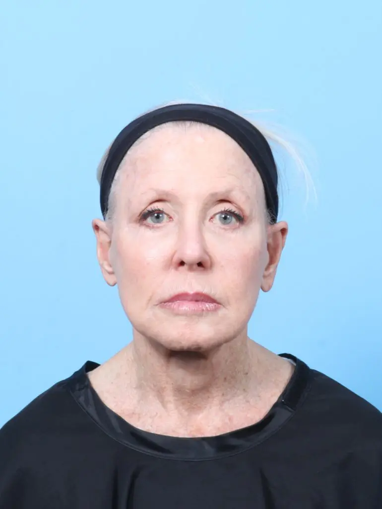 Facelift / Neck Lift - Case 62886 - After