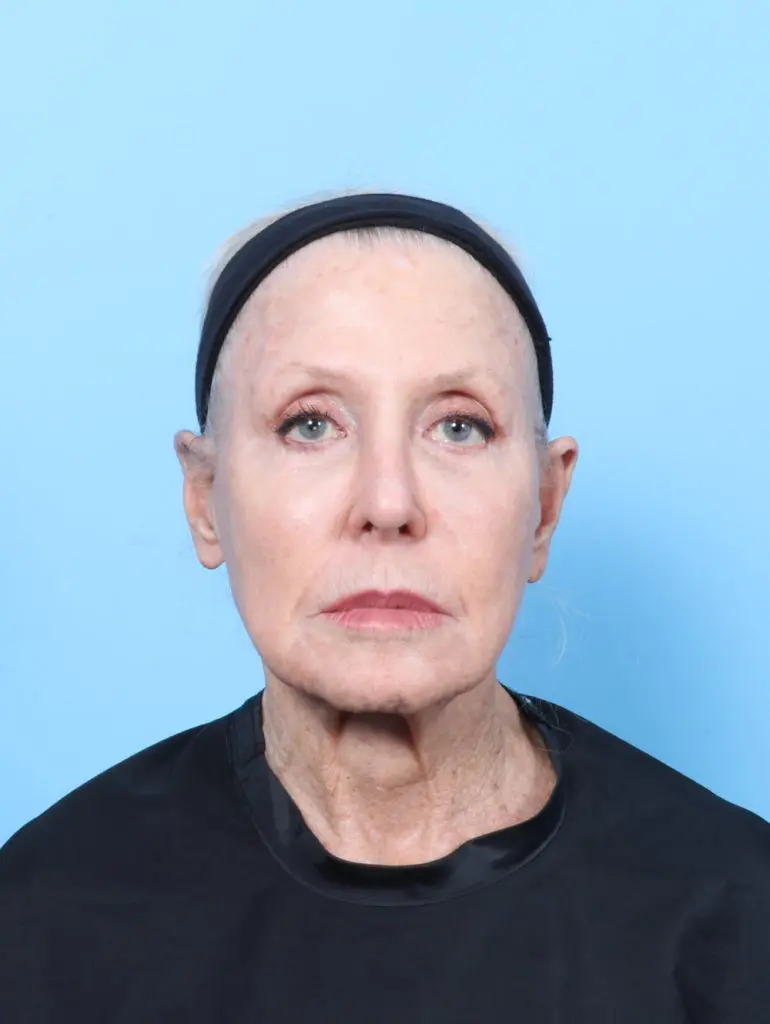 Facelift / Neck Lift - Case 62886 - Before