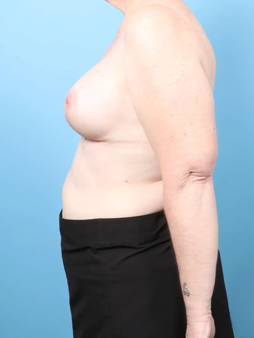 Breast Lift/Reduction with Implants Patient Photo - Case 62896 - after view-2