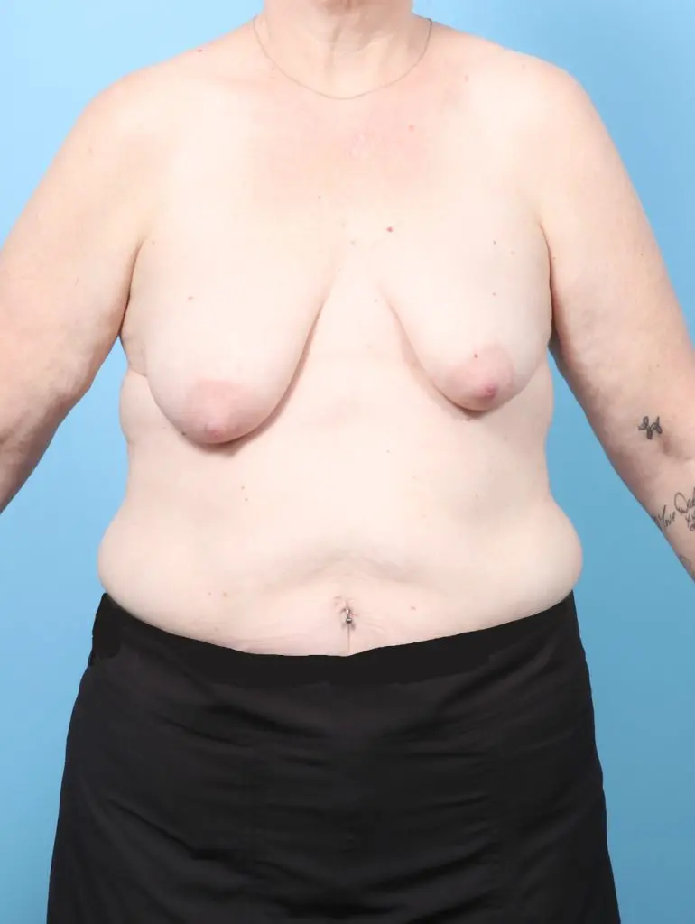 Breast Lift/Reduction with Implants - Case 62896 - Before