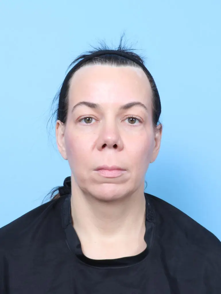 Eyelid Surgery - Case 62912 - Before