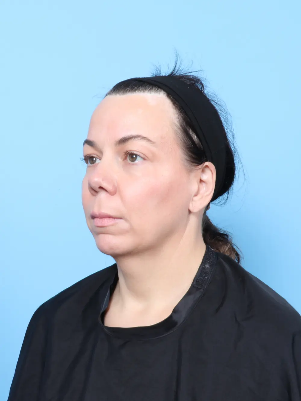 Eyelid Surgery Patient Photo - Case 62912 - before view-1