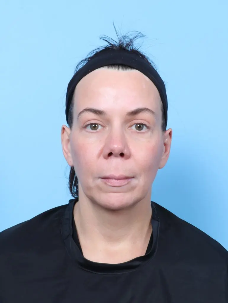 Eyelid Surgery - Case 62912 - After