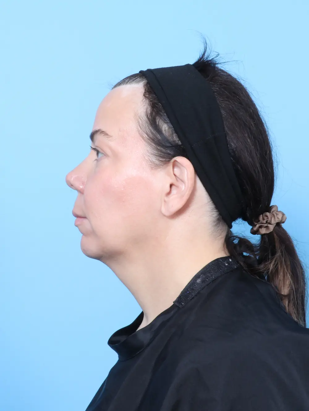 Eyelid Surgery Patient Photo - Case 62912 - before view-2