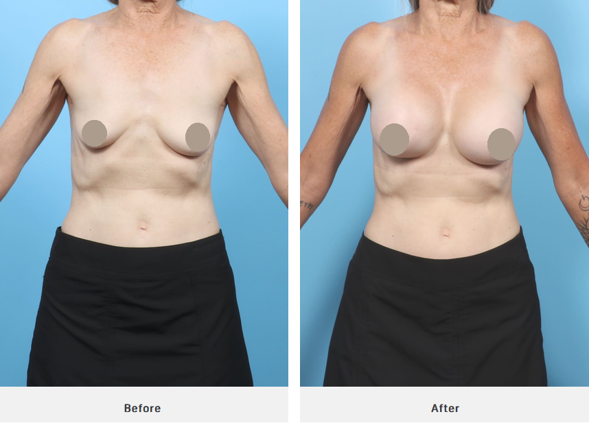 Before After 55714