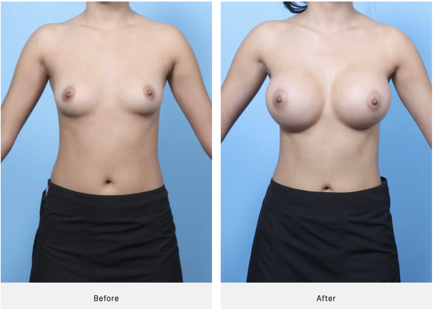 before and after breast augmentation case 2